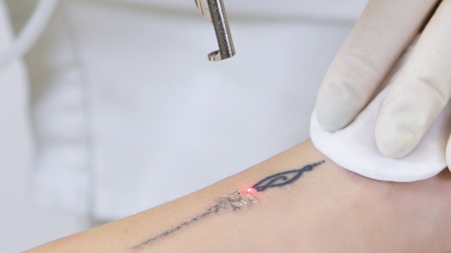 Cost Of Tattoo Removal – Options Depending On Budget