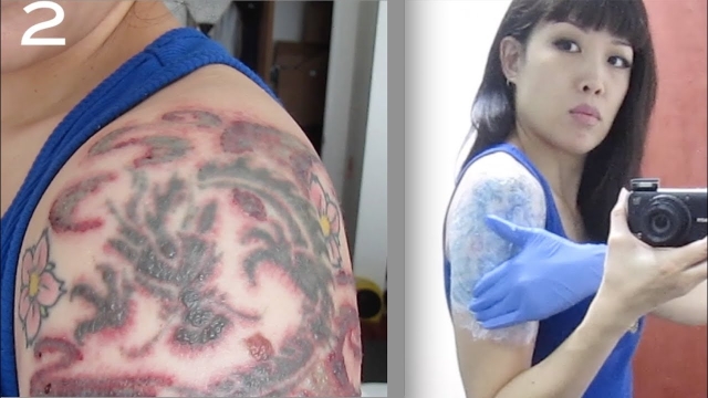 Laser – The New Technology For Tattoo Eliminating!