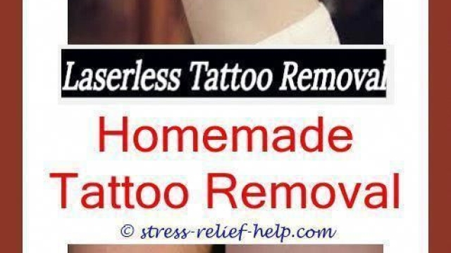 Tattoo Laser Removal –  Great Why Your Tattoo Should Go!
