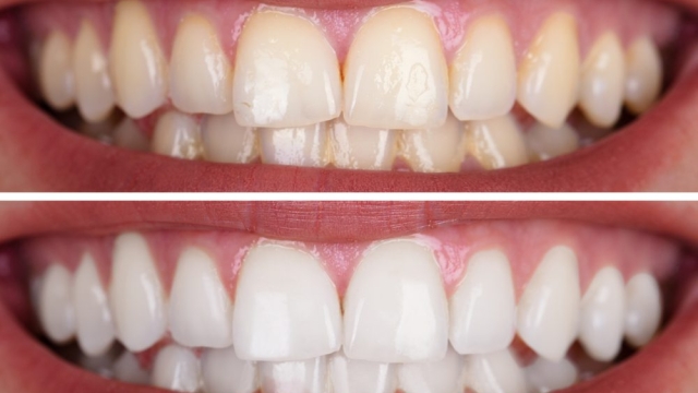 10 Brilliant Ways to Brighten Your Smile: Effective Teeth Whitening Strategies