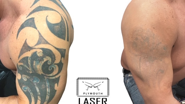 Choices And Methods For Tattoo Removal