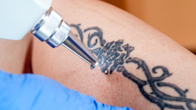 Tattoo Laser Removal –  3 Reasons Why Your Tattoo Should Go!