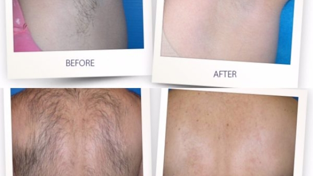 Smooth Solutions: Unveiling the Magic of Laser Hair Removal